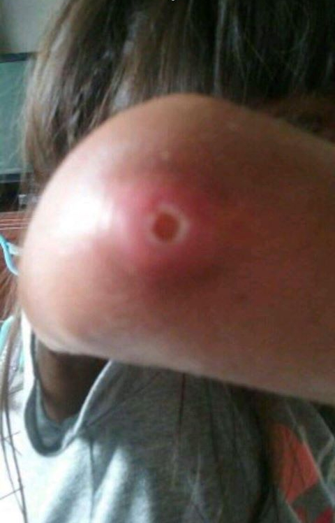 An ulcer on Angela's elbow
